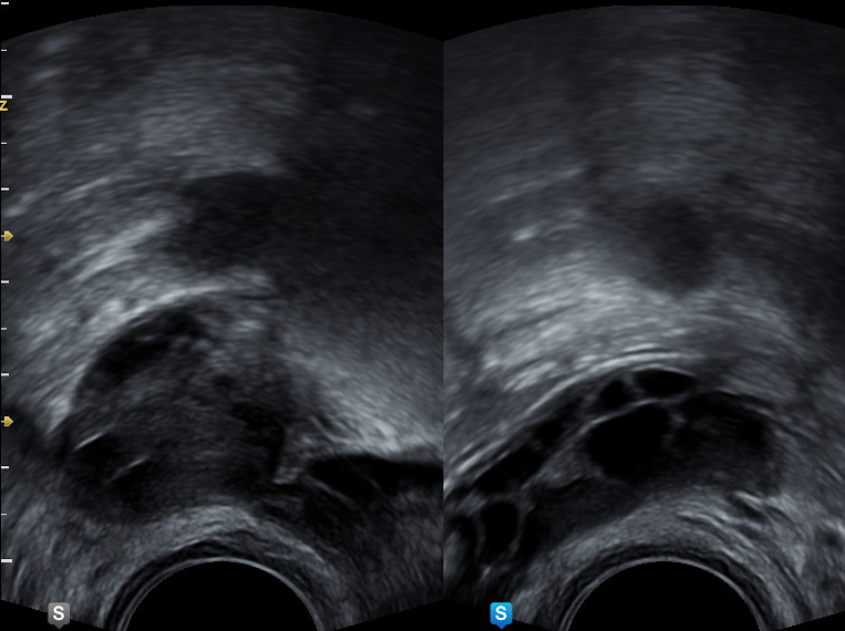 Ultraschalluntersuchung des linken und rechten Eierstocks